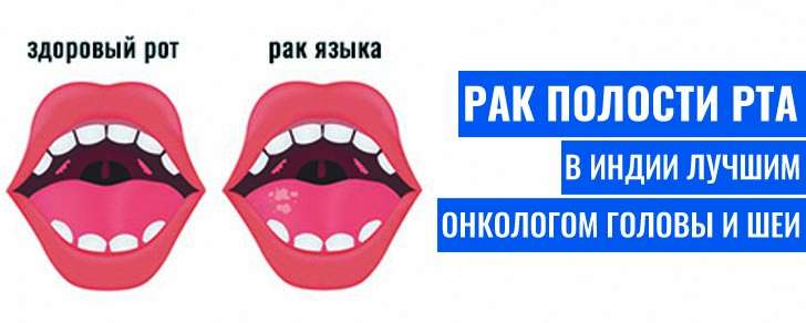 рак полости рта